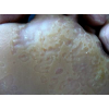 Que és la Queratolisi Plantar Sulcatum?