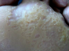 Que és la Queratolisi Plantar Sulcatum?